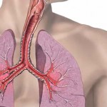 Bronhijalna-astma
