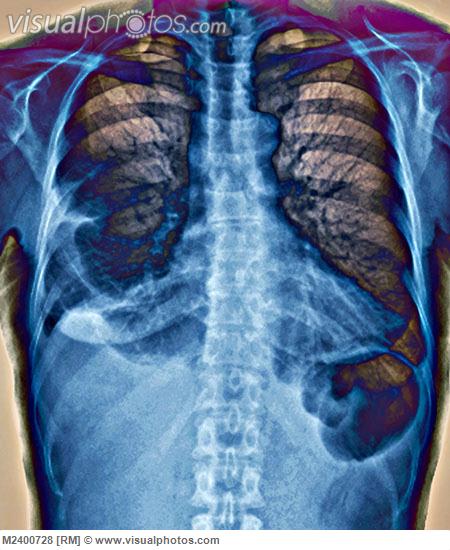 Pleurisy, X-ray