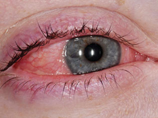 Alergije-oka