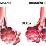 hronicni-bronhitis