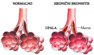 hronicni-bronhitis
